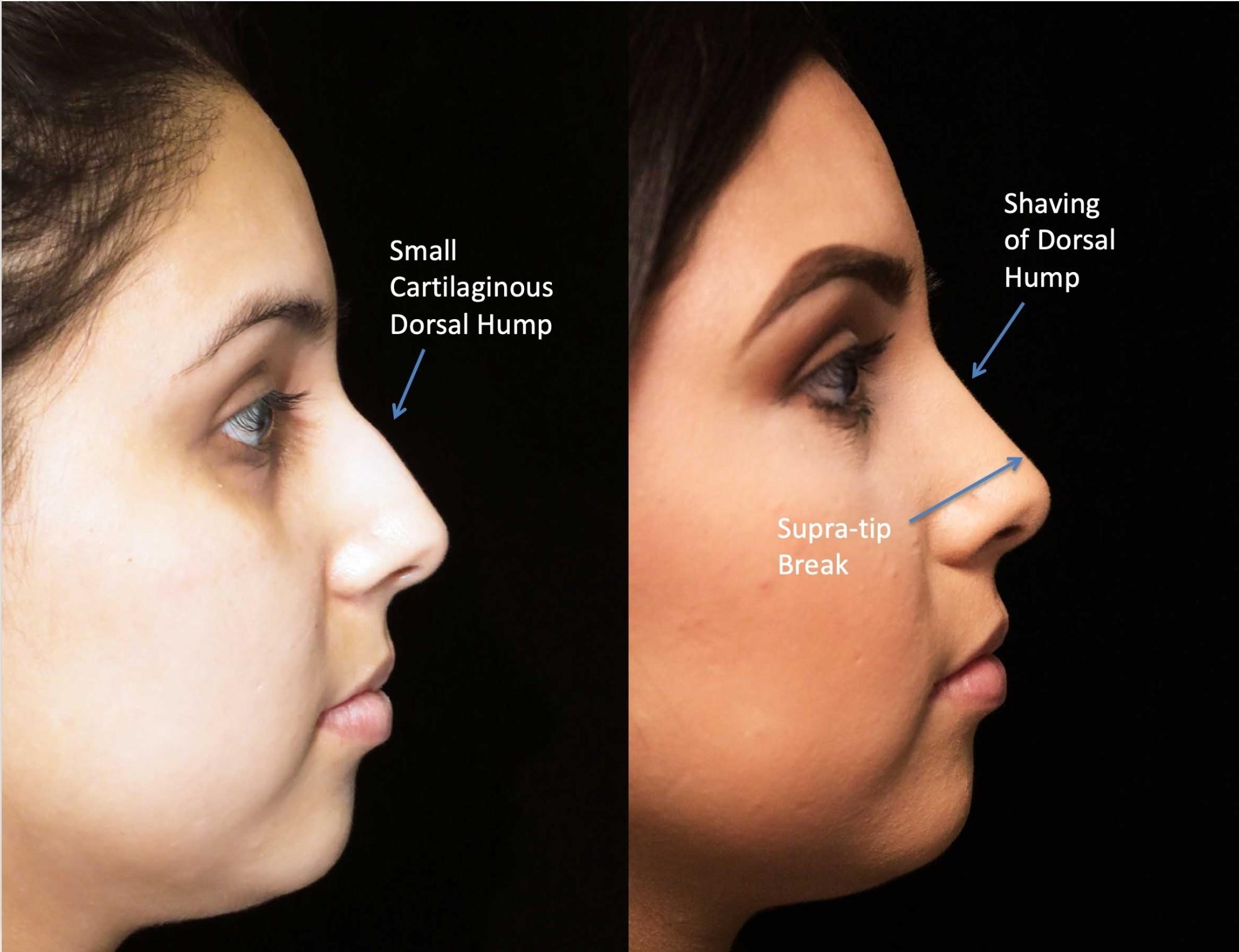 rhinoplasty expert