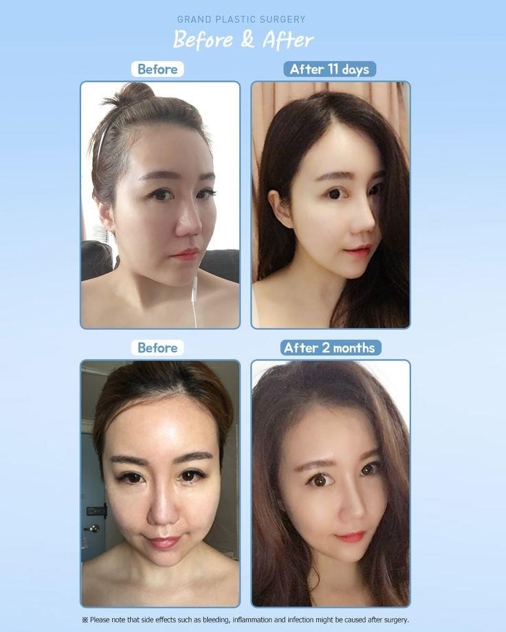 closed rhinoplasty near me