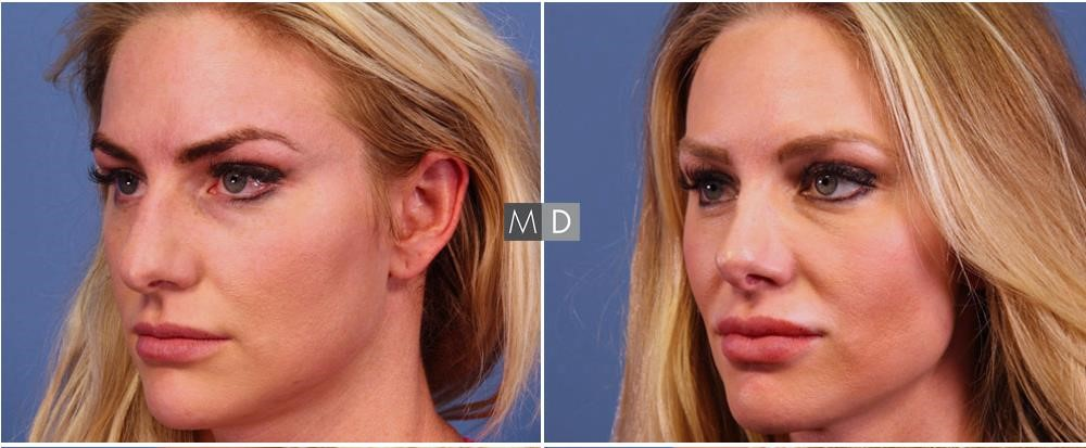 closed rhinoplasty near me