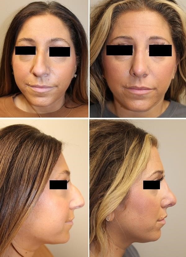 closed rhinoplasty near me