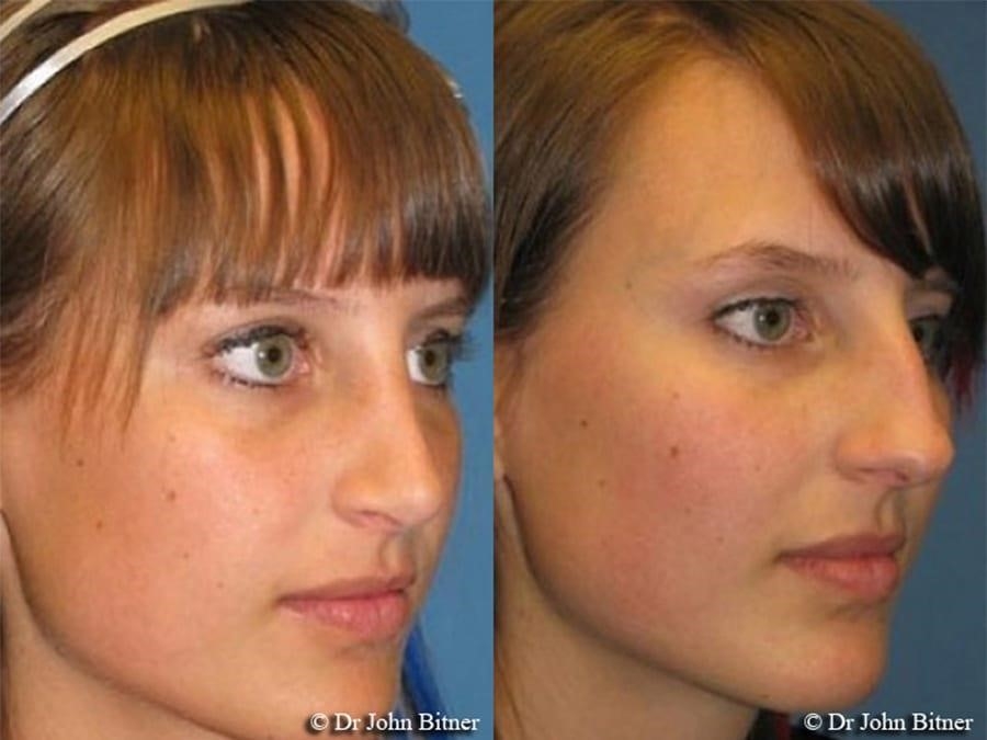 The Nose Job I Didn’t Get – rhinoplasty expert.